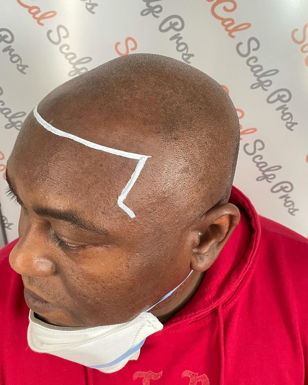 Scalp Mora Pigmentation | 1079 Lua Hala Canyon Rd, Vista, CA 92081, USA | Phone: (760) 583-4853