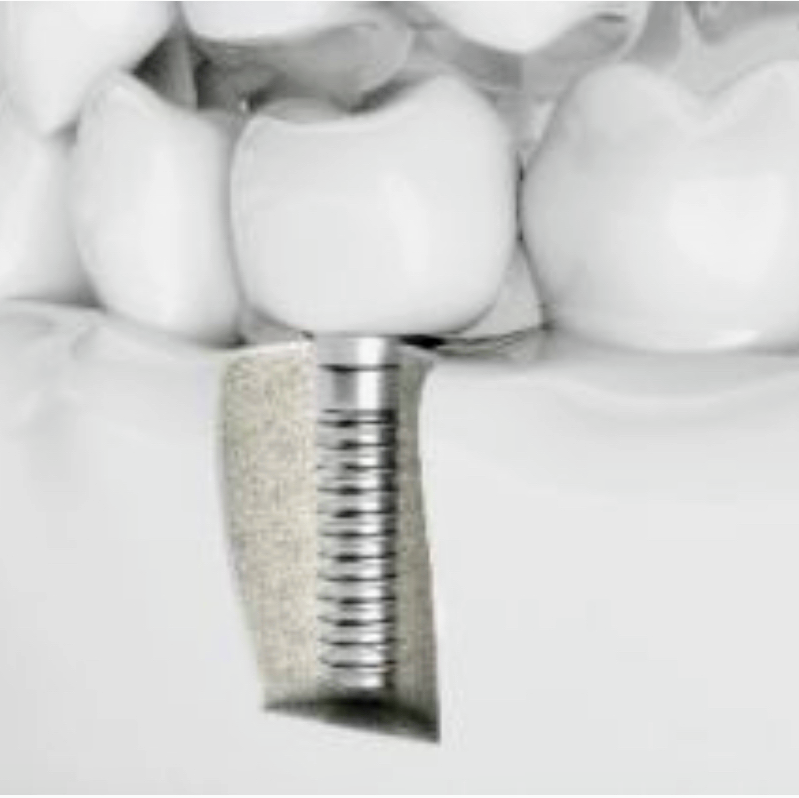 Mini Dental Implant Center | 120 Carter Blvd Suite 8, Polk City, FL 33868, USA | Phone: (863) 984-0000