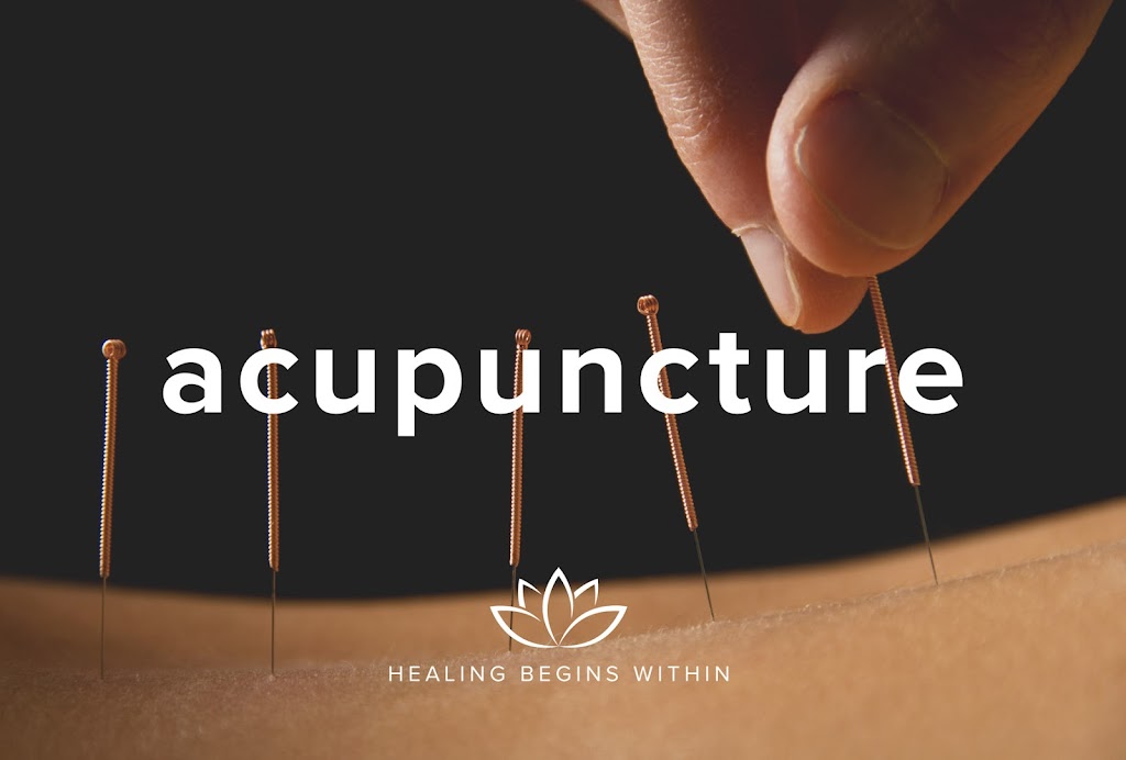 Acupuncture by Wan Qing-Cindy Zhang, M.S.Ac., L.Ac. | 10158 Niagara Falls Blvd, Niagara Falls, NY 14304, USA | Phone: (716) 298-0368