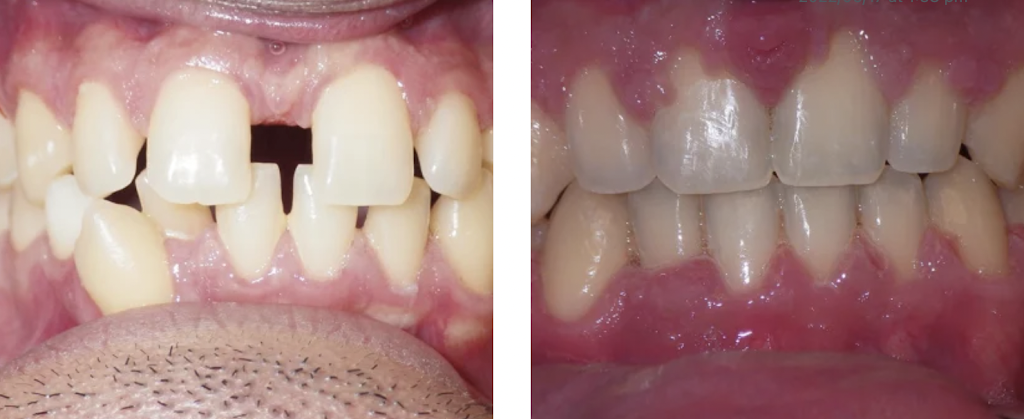 Due West Orthodontics | 3700 Largent Way #100, Marietta, GA 30064 | Phone: (770) 439-5101