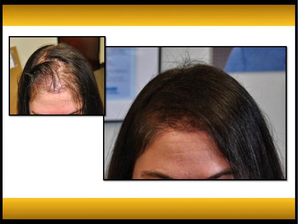 Fallon Hair Restoration | 9735 SW Shady Ln, Tigard, OR 97223, USA | Phone: (503) 941-5029