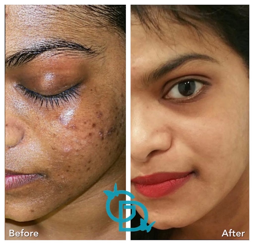 Glow DermSolutions San Jose | 6950 Santa Teresa Blvd STE E, San Jose, CA 95119, USA | Phone: (408) 794-5503 Glow DermSolutions San Jose | 6950 Santa Teresa Blvd STE E, San Jose, CA 95119, USA | Phone: (408) 794-5503