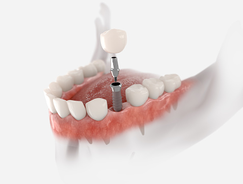 Denture Repair and Implants | 6441 Wilbur Ave, Reseda, CA 91335, USA | Phone: (213) 643-0135