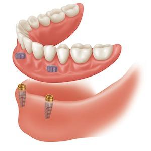 1st Class Dentures LLC | 6023 N Eagle Rd Suite 150, Boise, ID 83713, USA | Phone: (208) 336-8873