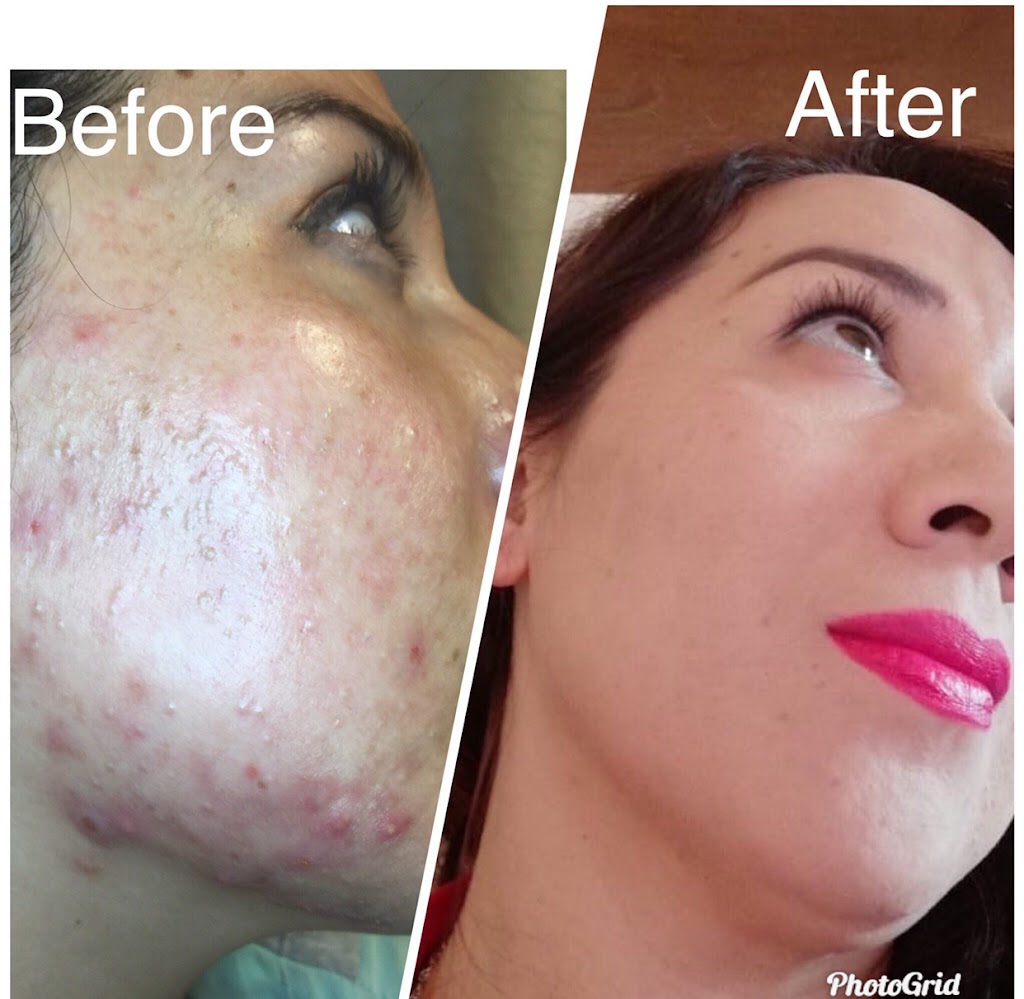 Elysian Skin & Acne Studio | Inside Legacy Salons & Spa, 420 E Round Grove Rd #200, Lewisville, TX 75067, USA | Phone: (214) 277-3888