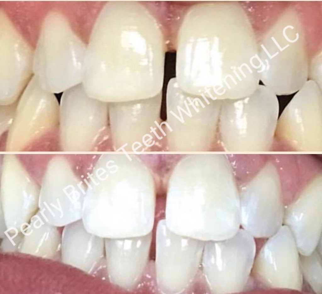 Pearly Brites Teeth Whitening, LLC | 2300 Rittenhouse St, Hyattsville, MD 20782, USA | Phone: (240) 801-3552