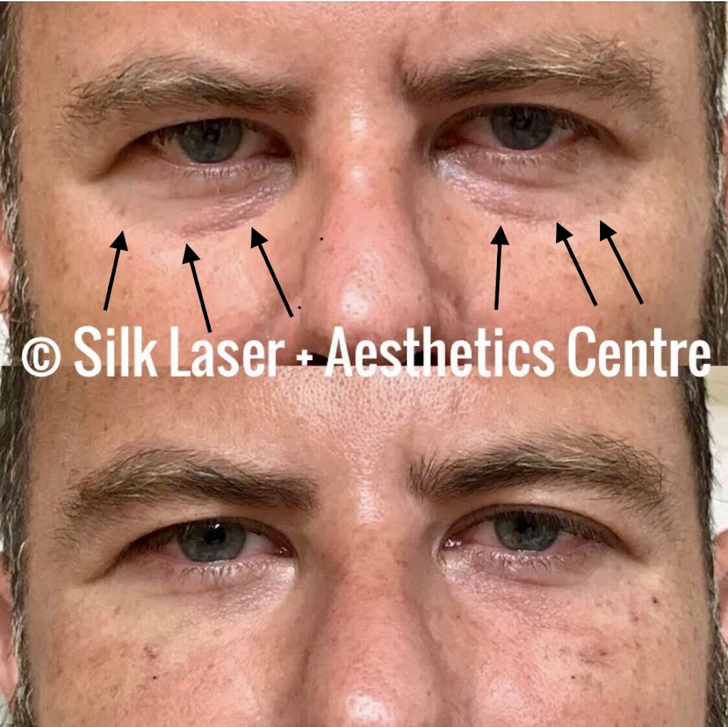 Silk Laser + Aesthetics Centre | 924 N Federal Hwy, Fort Lauderdale, FL 33304, USA | Phone: (954) 462-7455