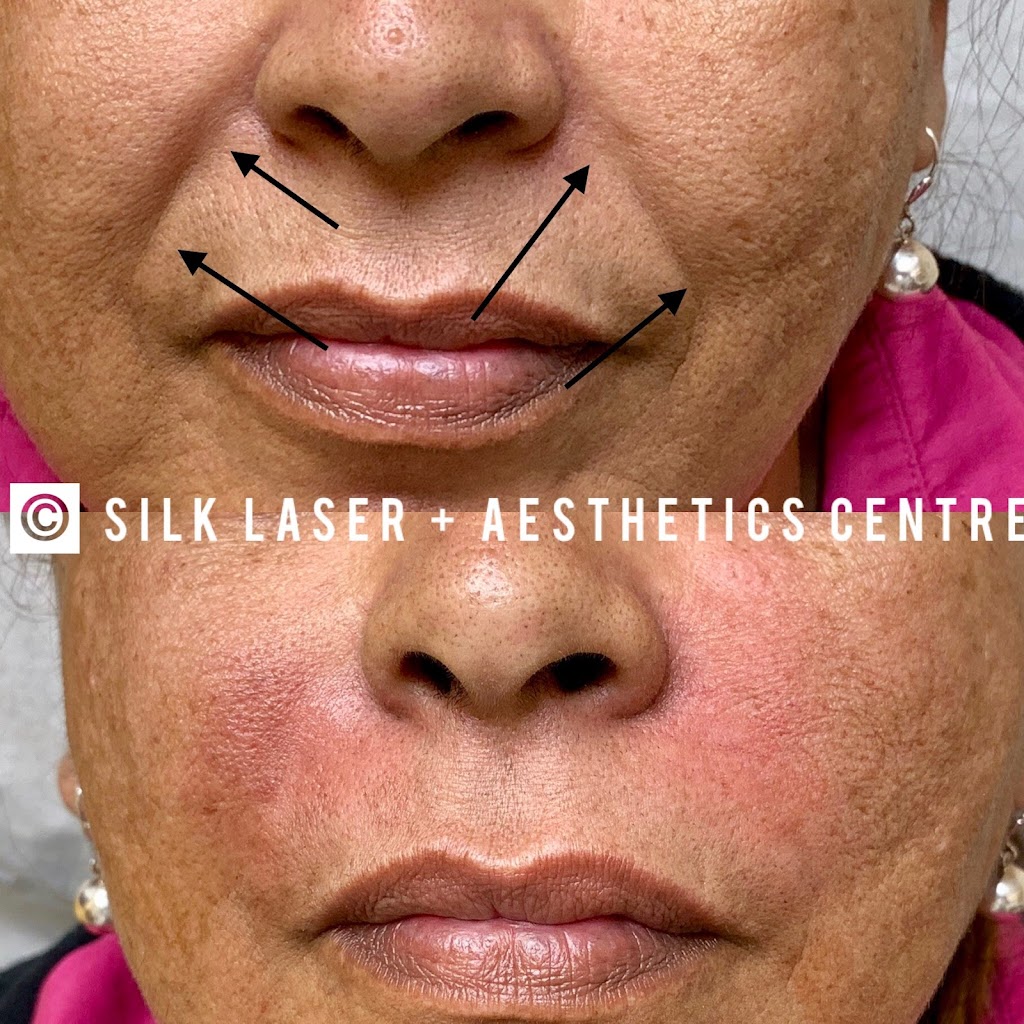 Silk Laser + Aesthetics Centre | 924 N Federal Hwy, Fort Lauderdale, FL 33304, USA | Phone: (954) 462-7455