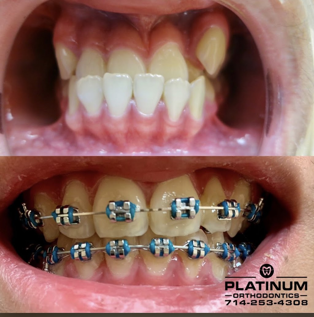 Platinum Orthodontics | 1332 E Chapman Ave, Fullerton, CA 92831, USA | Phone: (714) 253-4308