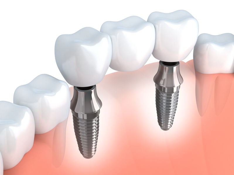 Roseville Dental Implants | 911 Reserve Dr, Roseville, CA 95678, USA | Phone: (916) 884-0727