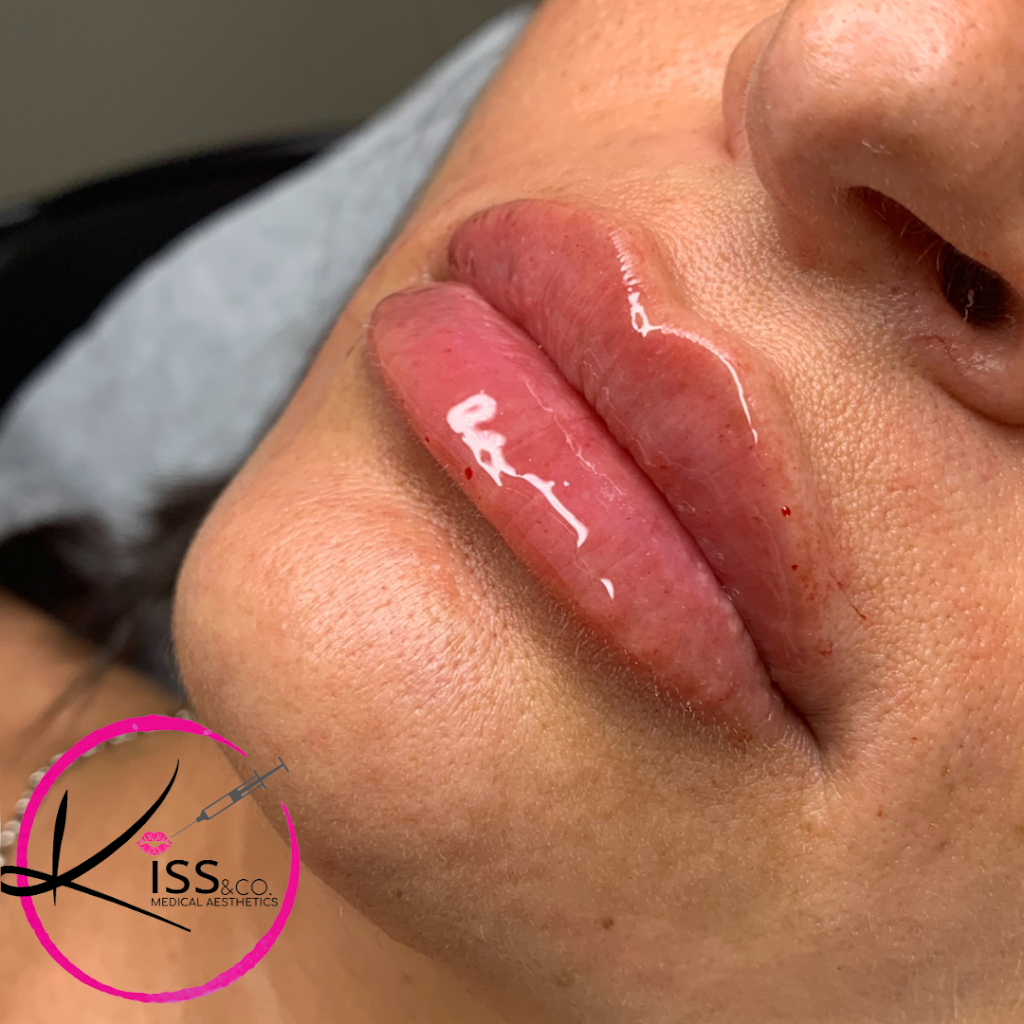 KISS Medical Aesthetics | 1081 Imperial Crescent, Windsor, ON N9G 2T4, Canada | Phone: (226) 350-1582