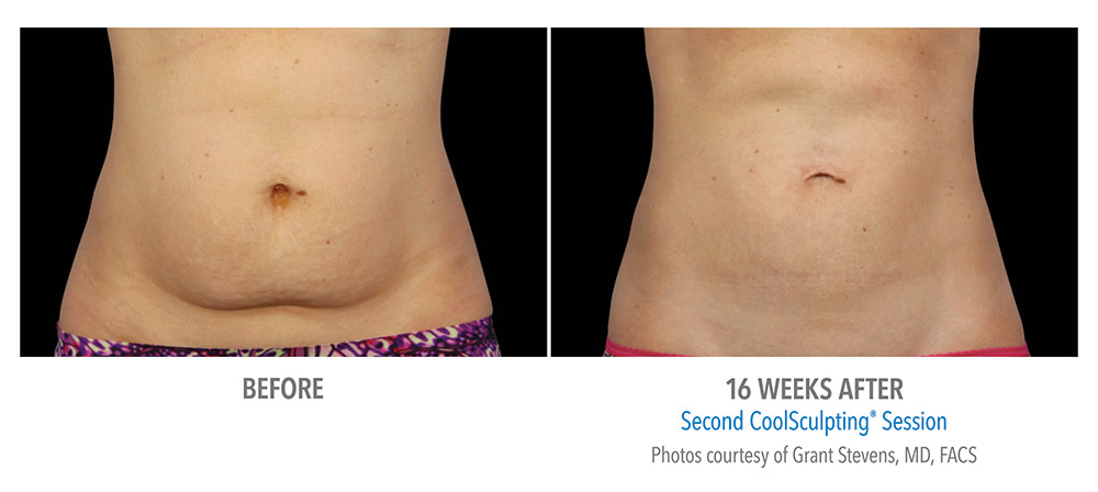 CoolSculpting of Dayton | 9240 Marketplace Dr, Miamisburg, OH 45342, USA | Phone: (937) 404-2665