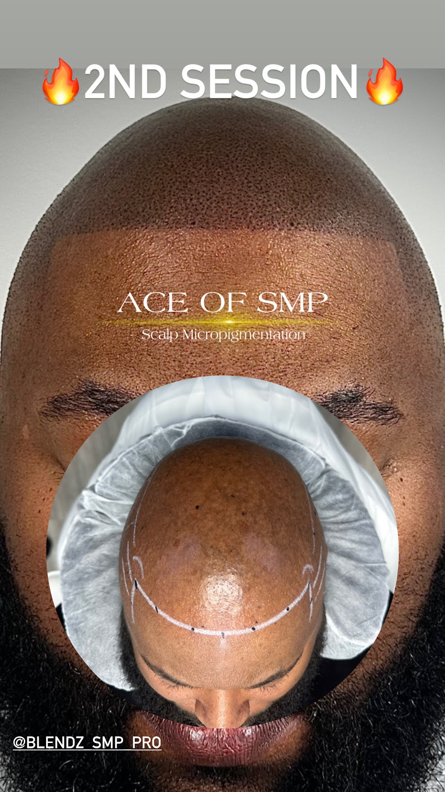 SCALP MICROPIGMENTATION | 2111 W Lincoln Hwy, Merrillville, IN 46410, USA | Phone: (630) 486-4502