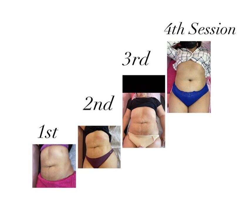 Crere Bodysculpting | 8035 E R L Thornton Fwy Suite 518 C, Dallas, TX 75228, USA | Phone: (469) 890-5824