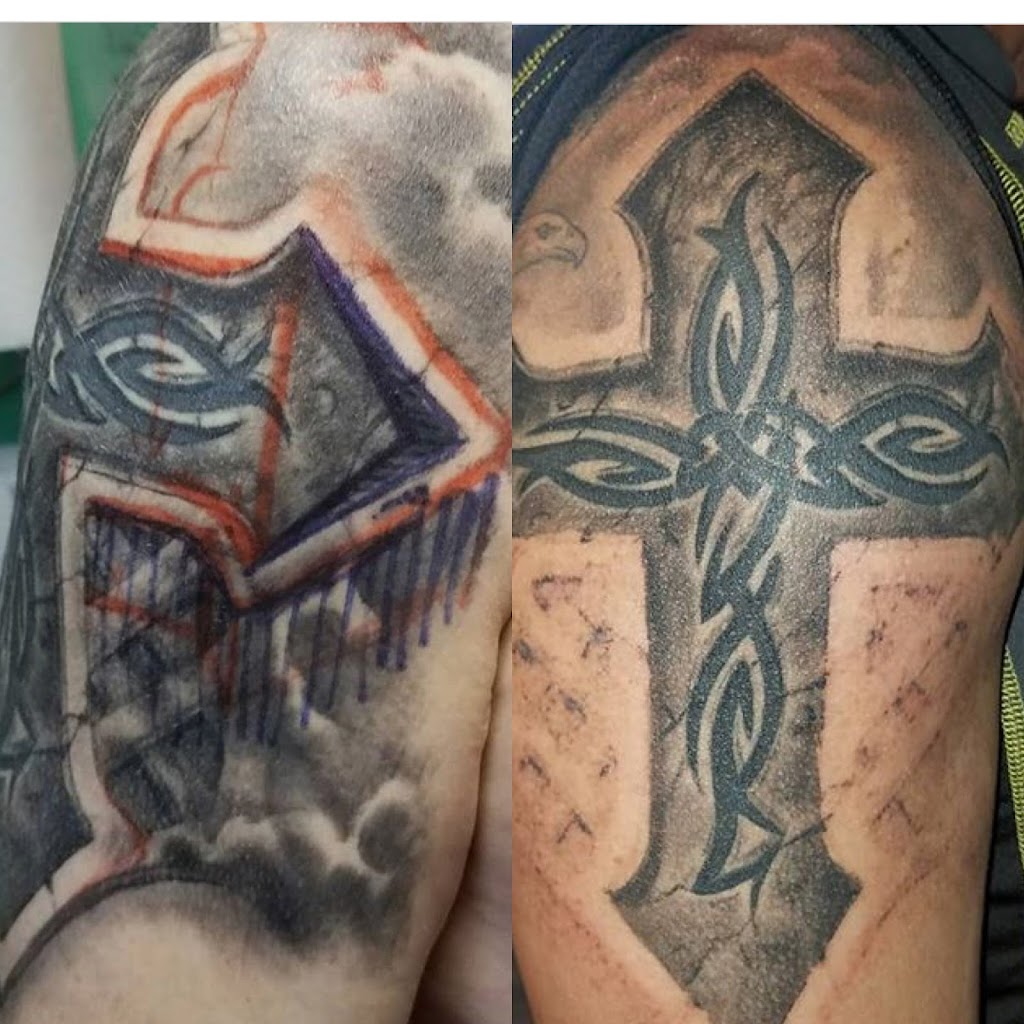 CS Tattoo Removal | 5 S Allen St #2201, Albany, NY 12208, USA | Phone: (518) 689-0730