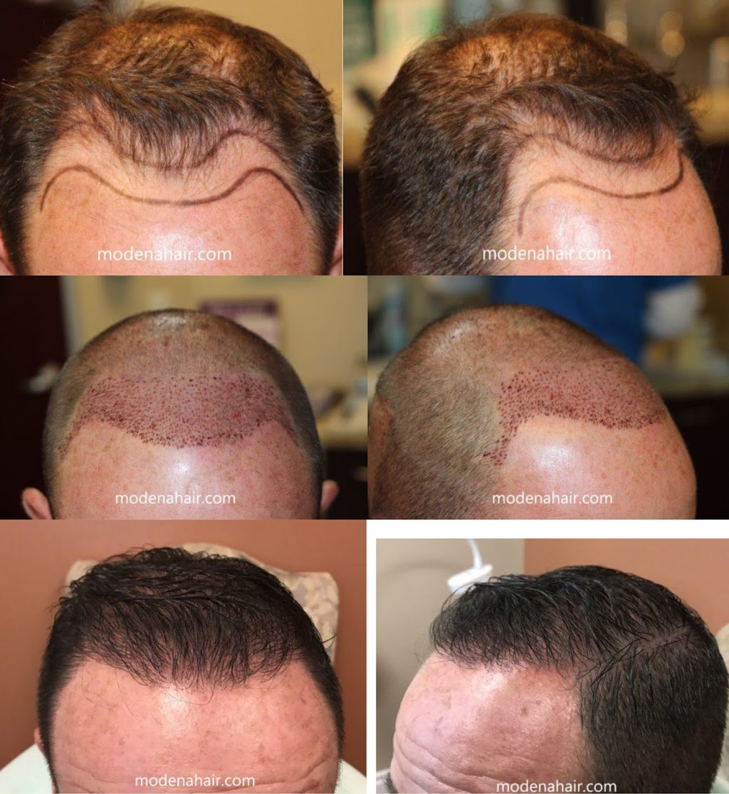 Modena Hair Transplant Institute | 2629 W Horizon Ridge Pkwy Suite #110, Henderson, NV 89052, USA | Phone: (702) 966-5134 Modena Hair Transplant Institute | 2629 W Horizon Ridge Pkwy Suite #110, Henderson, NV 89052, USA | Phone: (702) 966-5134