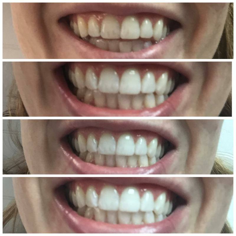 Malibu Teeth Whitening, Inc | 2103 E Parham Rd #204, Henrico, VA 23228, USA | Phone: (804) 629-3390