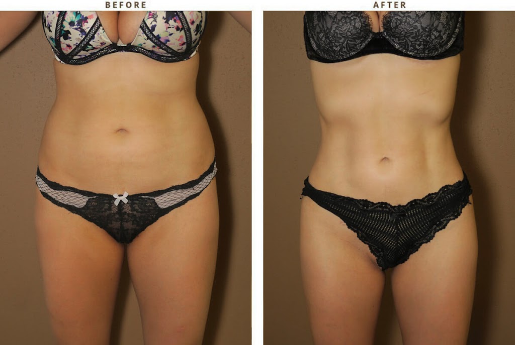 Preferred One Body Sculpting | 8450 Chapel Hill Rd Suite 201, Cary, NC 27513, USA | Phone: (919) 428-4164