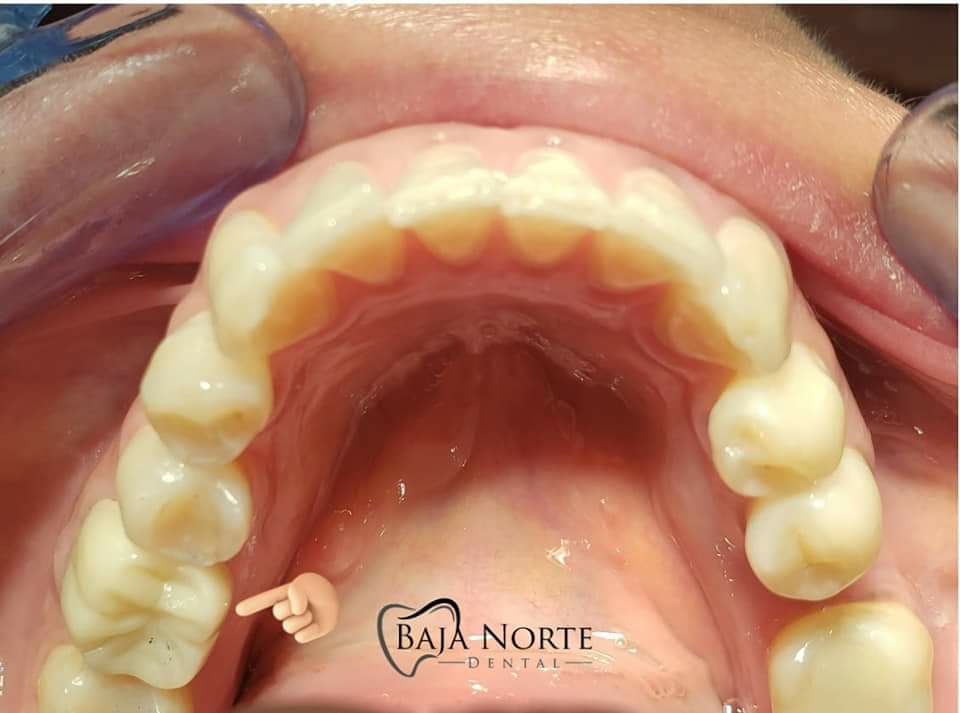 Baja Norte Dental | Calle, Valentín Ruiz Pimentel no.143-Local 8H, Amp Lucio Blanco, 22710 Rosarito, B.C., Mexico | Phone: 661 108 4354