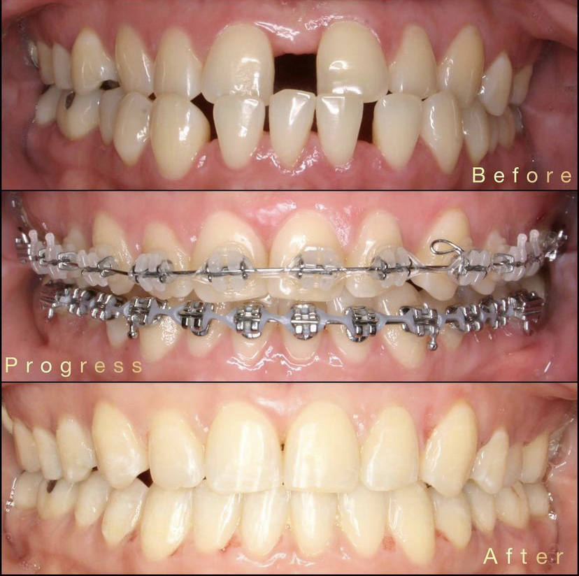 Ramaswamy Orthodontics - Braces, Invisalign Orthodontist | 515 NY-304 Suite 2F-W, New City, NY 10956, USA | Phone: (845) 634-9603