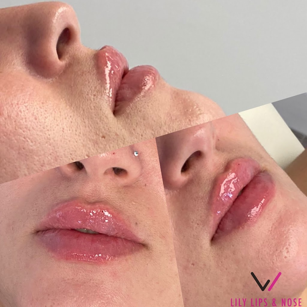 Lily Lips & Nose | 8360 W Flagler St # 104, Miami, FL 33144, USA | Phone: (786) 427-7442