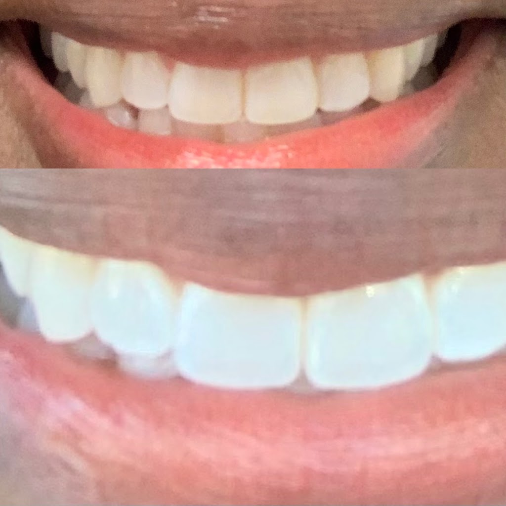 Simple Whiter Teeth | Forney, Tx. 75126. &, Wylie, TX 75098 | Phone: (214) 605-2494
