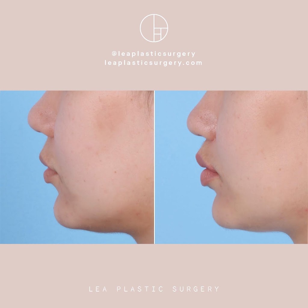 LEA Plastic Surgery - Goretti Ho Taghva MD, FACS | 20360 SW Birch St #180, Newport Beach, CA 92660, USA | Phone: (949) 945-2168