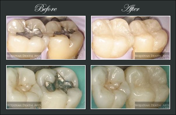 Sequoyah Dental Arts | 2719 Kingston Pike, Knoxville, TN 37919, United States | Phone: (865) 973-9899