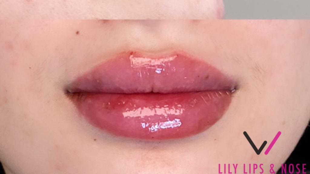 Lily Lips & Nose | 8360 W Flagler St # 104, Miami, FL 33144, USA | Phone: (786) 427-7442