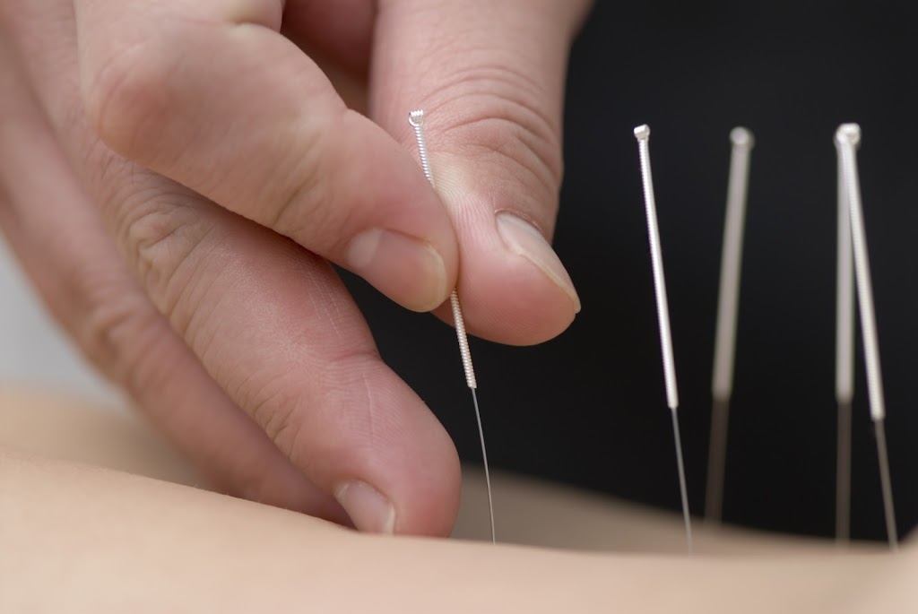 Acupuncture by Wan Qing-Cindy Zhang, M.S.Ac., L.Ac. | 10158 Niagara Falls Blvd, Niagara Falls, NY 14304, USA | Phone: (716) 298-0368