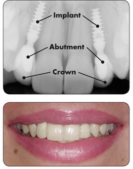 Silicon Valley Dental Center | 5710 Cahalan Ave Building 8K, San Jose, CA 95123, USA | Phone: (408) 578-5911