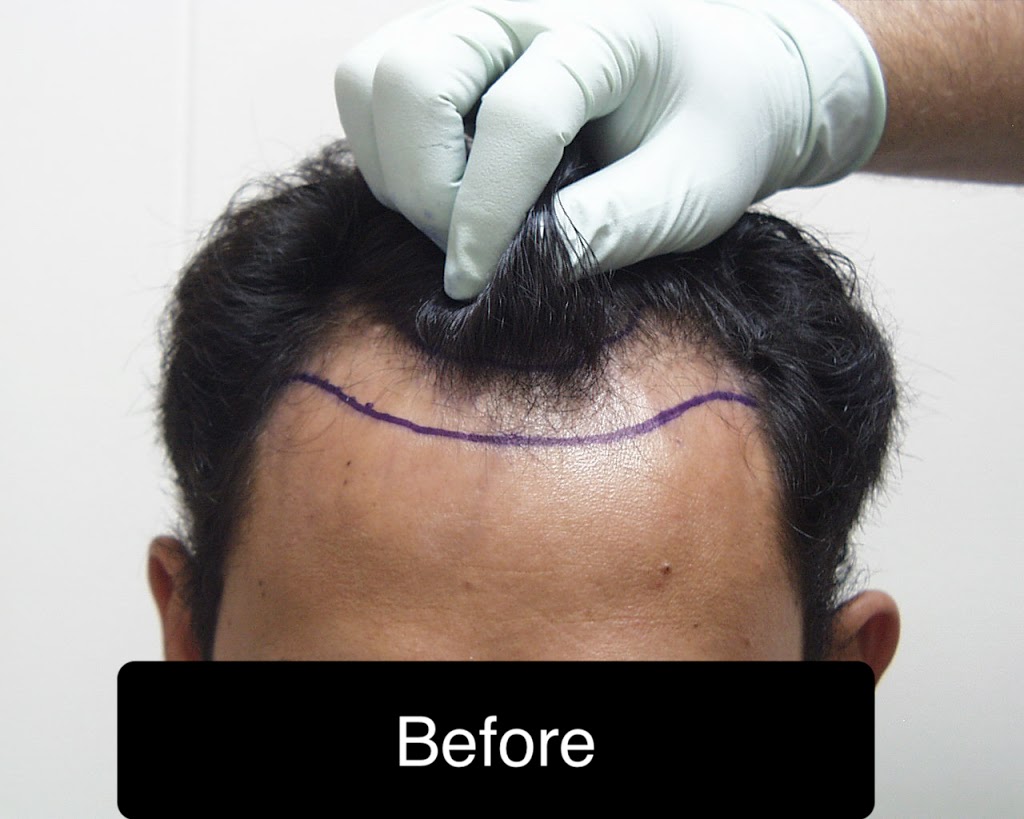 AZ Hair Restoration | 6400 Creedmoor Rd #104, Raleigh, NC 27613, USA | Phone: (919) 830-3778 AZ Hair Restoration | 6400 Creedmoor Rd #104, Raleigh, NC 27613, USA | Phone: (919) 830-3778