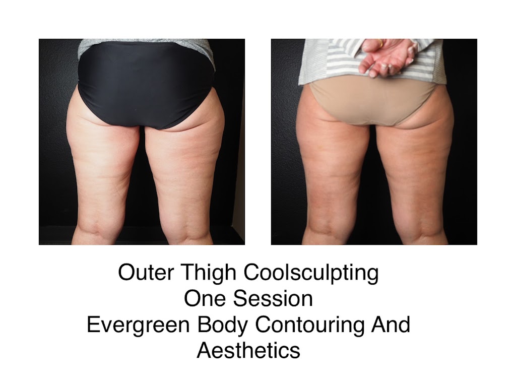 Evergreen Body Contouring | 4011 Evergreen Pkwy, Evergreen, CO 80439, USA | Phone: (720) 366-8419