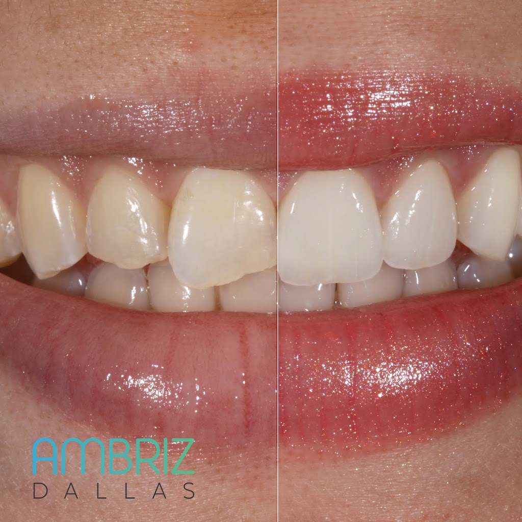 Ambriz Dental | 9400 N US 75-Central Expy 1000 Suite #220, Dallas, TX 75231, USA | Phone: (214) 368-0514