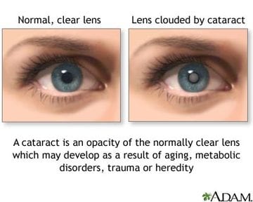Eye One Surgical Associates | 6510 Kenilworth Ave Suite 1300, Riverdale, MD 20737 | Phone: (301) 699-1882