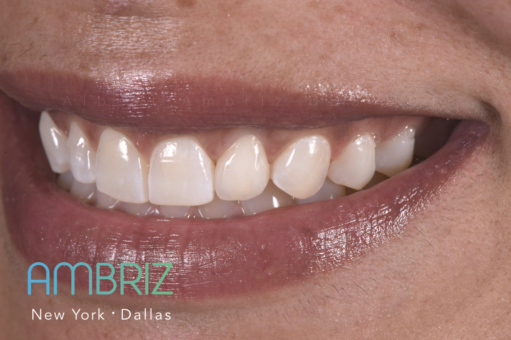 Ambriz Dental | 9400 N US 75-Central Expy 1000 Suite #220, Dallas, TX 75231, USA | Phone: (214) 368-0514