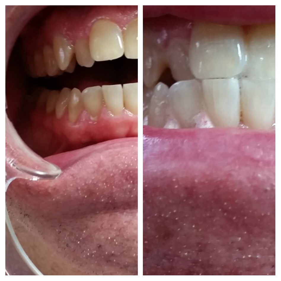 Malibu Teeth Whitening, Inc | 2103 E Parham Rd #204, Henrico, VA 23228, USA | Phone: (804) 629-3390
