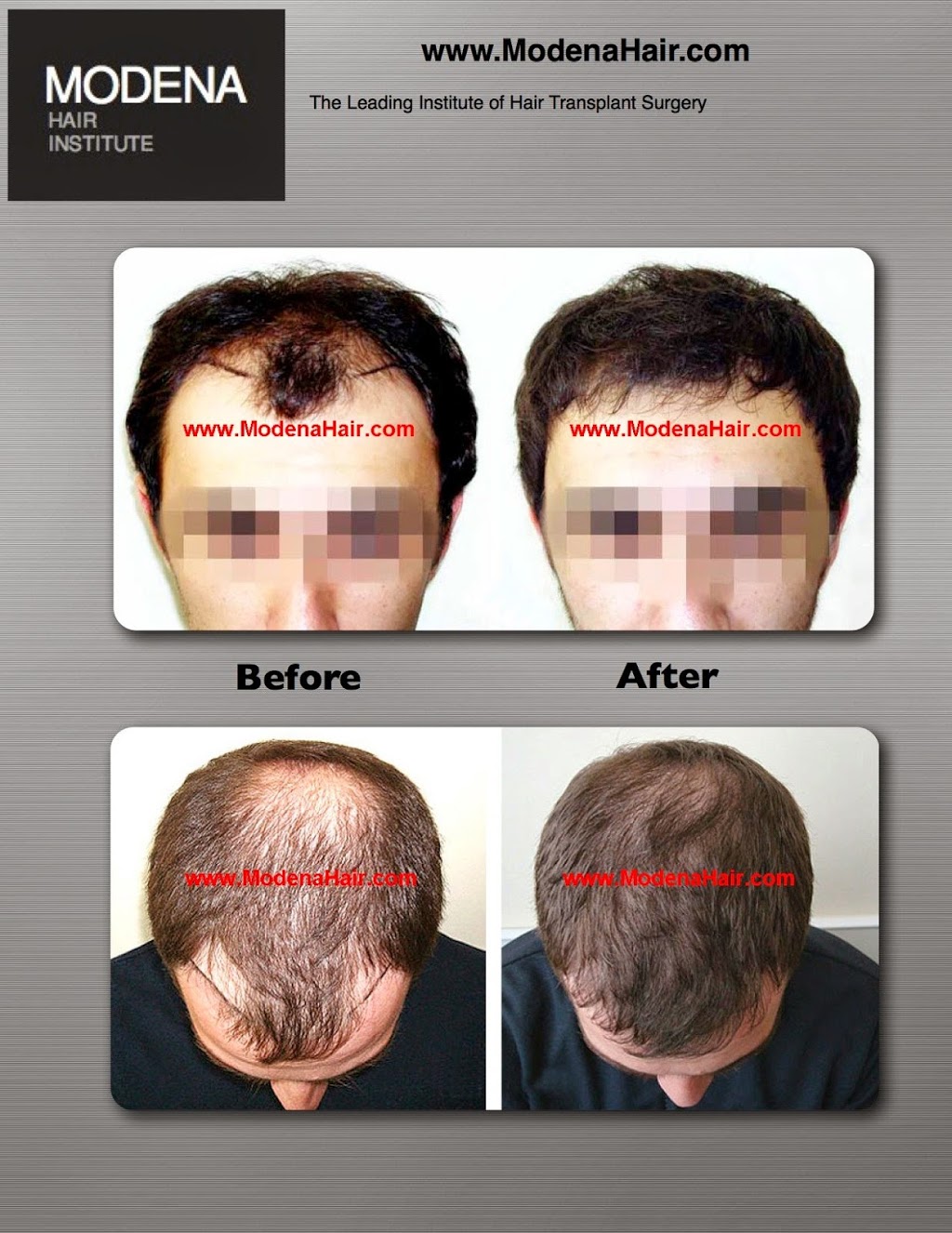 Modena Hair Transplant Institute | 2629 W Horizon Ridge Pkwy Suite #110, Henderson, NV 89052, USA | Phone: (702) 966-5134 Modena Hair Transplant Institute | 2629 W Horizon Ridge Pkwy Suite #110, Henderson, NV 89052, USA | Phone: (702) 966-5134