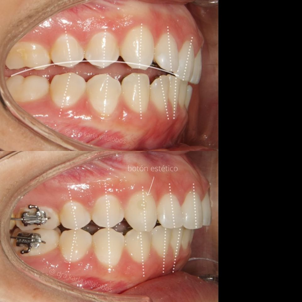 Implantes dentales en Tijuana - DENTOK México | Diego Rivera 2311-Int. 404, Zona Urbana Rio Tijuana, 22010 Tijuana, B.C., Mexico | Phone: 664 630 5194