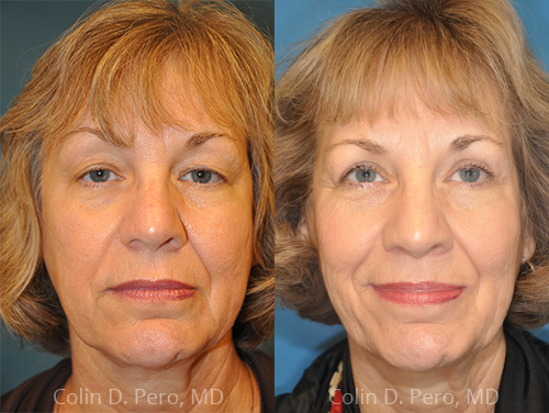 North Texas Facial Plastic Surgery | 5426 W Spring Creek Pkwy Suite 145, Plano, TX 75024, USA | Phone: (469) 437-7041