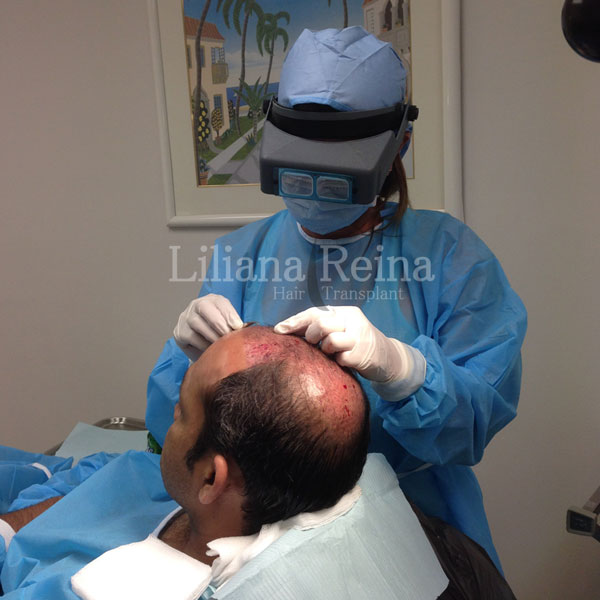 Reina Hair Transplant | 90 Indian Trace, Weston, FL 33326 | Phone: (561) 703-3253