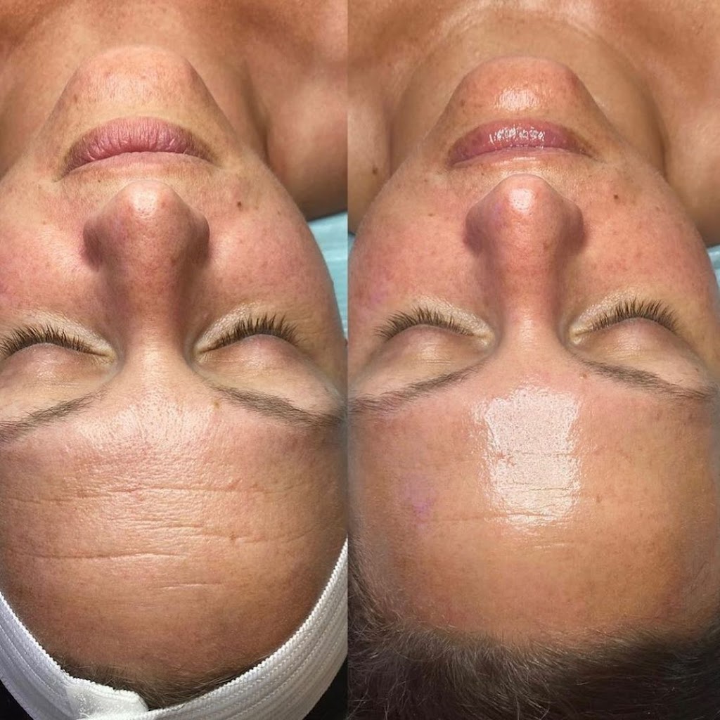 HydraFacial By Jen | 2314 N 154th St, Omaha, NE 68116, USA | Phone: (657) 777-0496