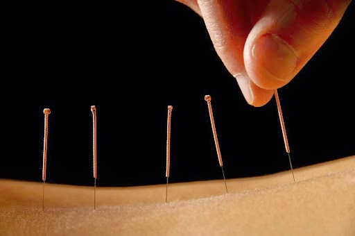 Advanced Acupuncture & Pain Management Clinic | 2129 2nd St, White Bear Lake, MN 55110, USA | Phone: (612) 547-9301