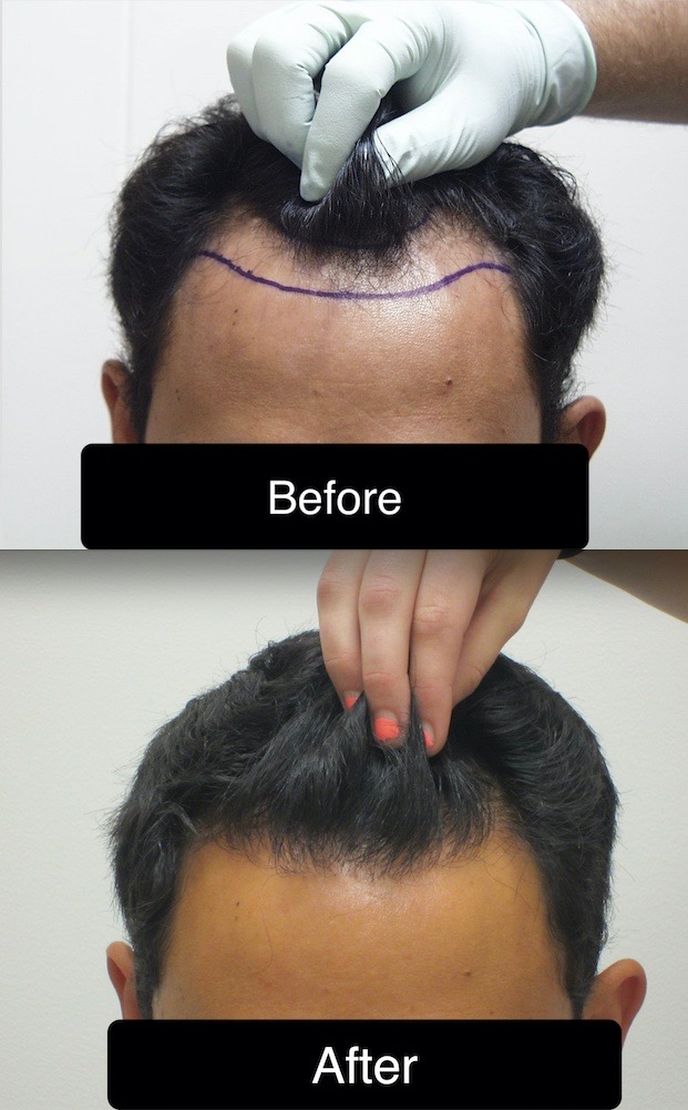 AZ Hair Restoration | 6400 Creedmoor Rd #104, Raleigh, NC 27613, USA | Phone: (919) 830-3778 AZ Hair Restoration | 6400 Creedmoor Rd #104, Raleigh, NC 27613, USA | Phone: (919) 830-3778