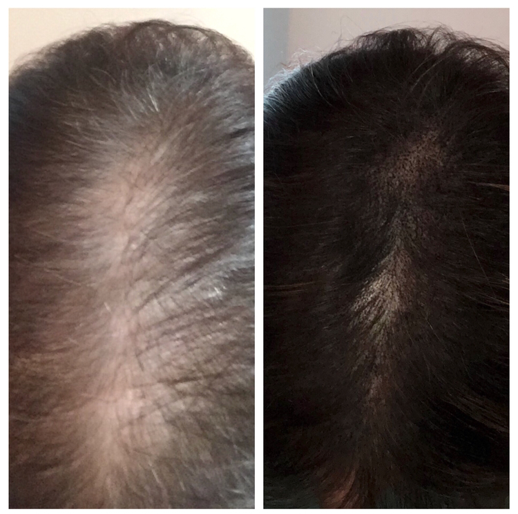 Scalp Renewal | 727 Muller Rd, Westminster, MD 21157, USA | Phone: (443) 562-5520