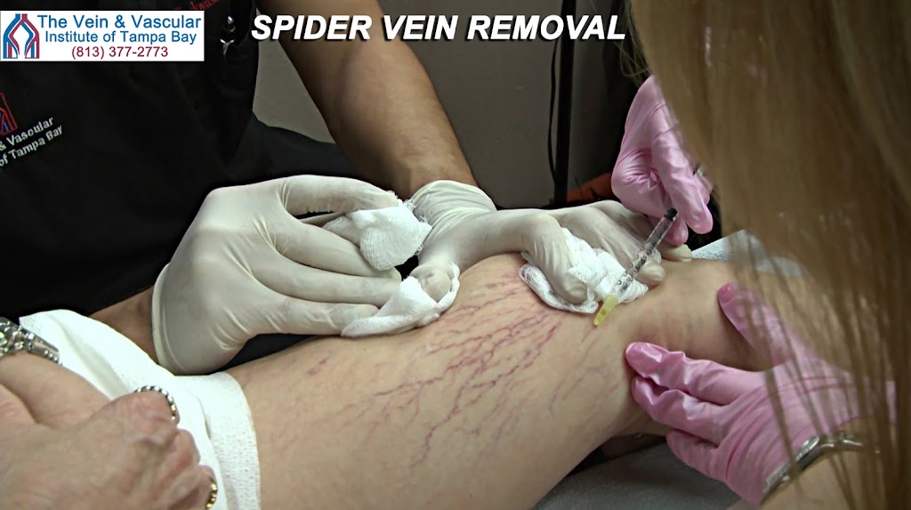 Spider Vein Treatment Specialist - Holly-Ann Kerr, ARNP | 19185 N Dale Mabry Hwy, Lutz, FL 33548, USA | Phone: (813) 387-3038