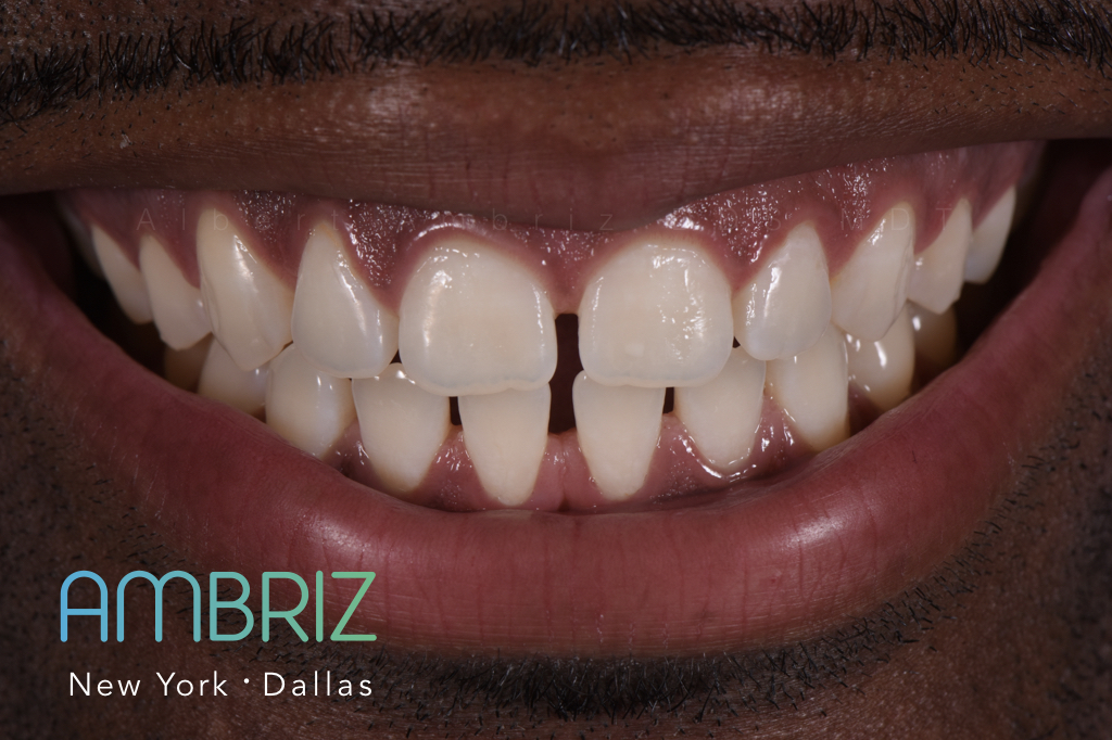 Ambriz Dental | 9400 N US 75-Central Expy 1000 Suite #220, Dallas, TX 75231, USA | Phone: (214) 368-0514