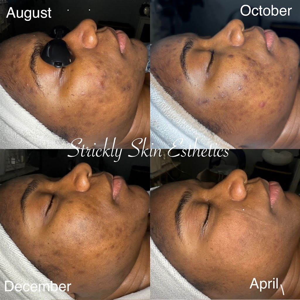 Strickly Skin Esthetics | 105 E Oak St Ste. 101, Mansfield, TX 76063, USA | Phone: (817) 320-8485