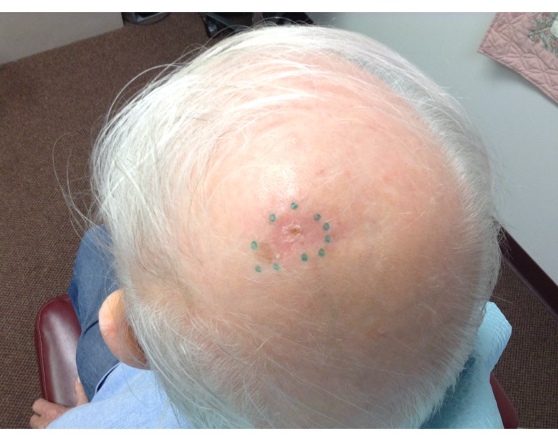 Dermatology Partners | 400 Cresson Blvd Suite 320, Oaks, PA 19456, USA | Phone: (610) 994-2250