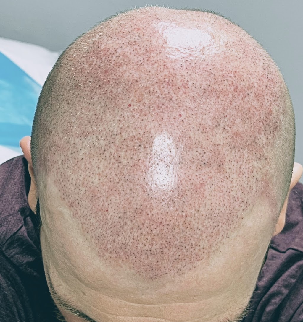 New You Ink Scalp Micropigmentation and Aesthetics | 1348 Sharon Copley Rd, Wadsworth, OH 44281, USA | Phone: (216) 626-5311